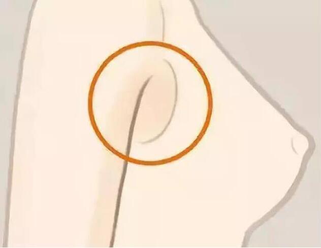 減副乳，瘦手臂一招就解決！