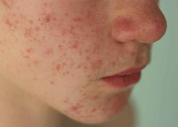 粉刺閉口應(yīng)該如何處理？