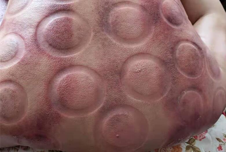 怎樣拔火罐？南寧美容學(xué)校手把手教你