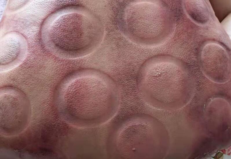 拔火罐有什么用？廣西美容職業(yè)培訓(xùn)學(xué)校演示給你看