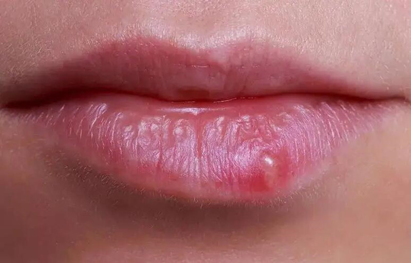 紋唇后起泡怎么辦？南寧紋唇培訓(xùn)學(xué)校教你方法