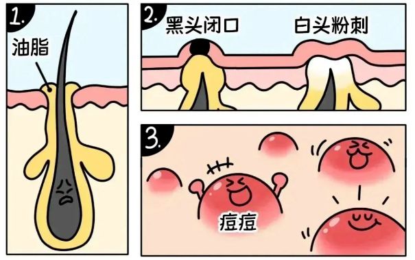 不同部位閉口形成的原因，南寧美容護膚學校解答