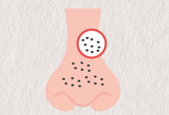 廣西皮膚管理師：面對(duì)嚴(yán)重的黑頭應(yīng)該怎么辦？